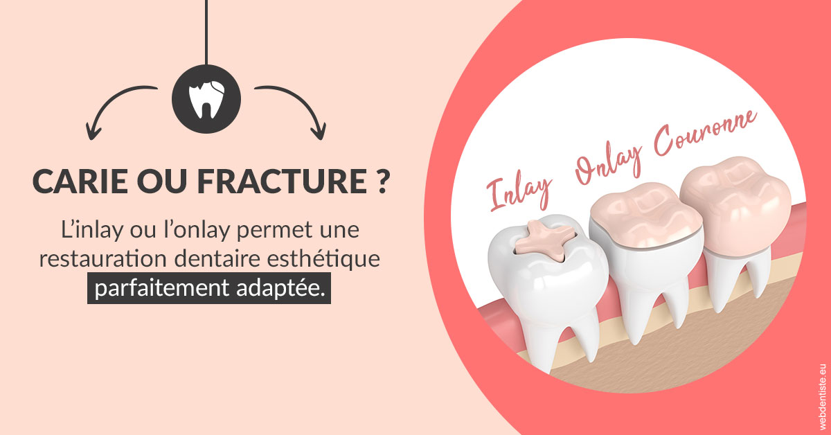 https://selarl-berdah.chirurgiens-dentistes.fr/T2 2023 - Carie ou fracture 2