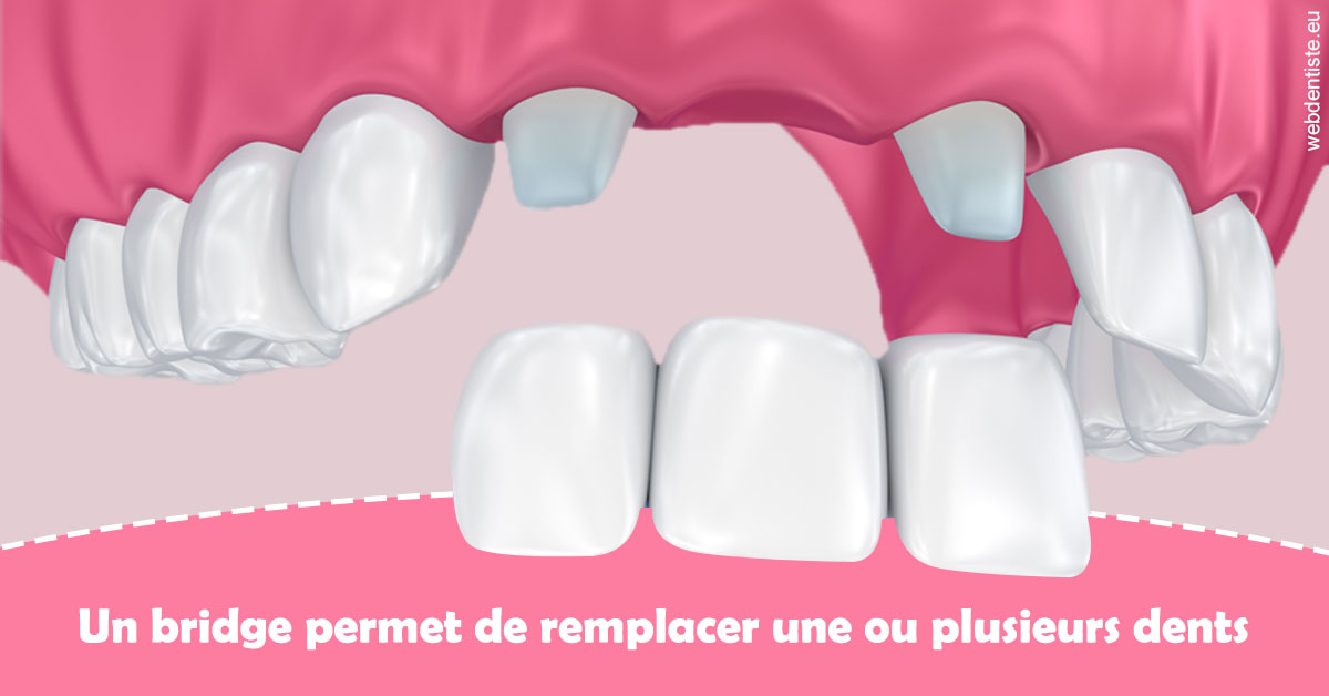 https://selarl-berdah.chirurgiens-dentistes.fr/Bridge remplacer dents 2