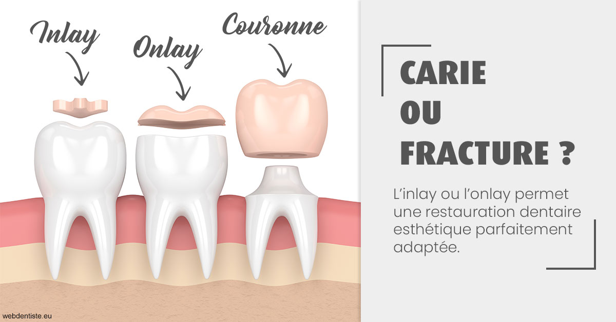 https://selarl-berdah.chirurgiens-dentistes.fr/T2 2023 - Carie ou fracture 1