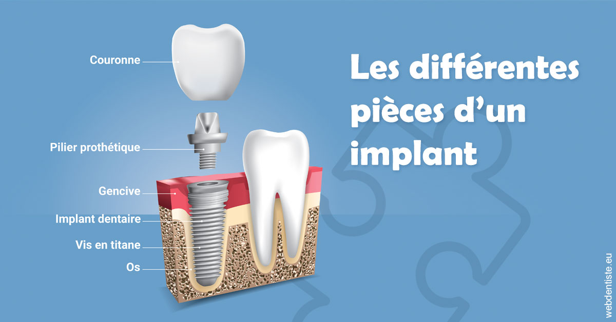https://selarl-berdah.chirurgiens-dentistes.fr/Les différentes pièces d’un implant 1